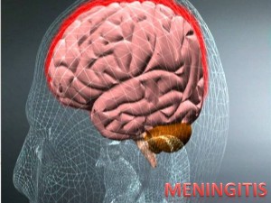 MENINGITIS