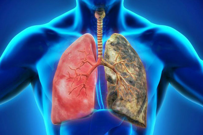 ¿Qué es la enfermedad de EPOC?